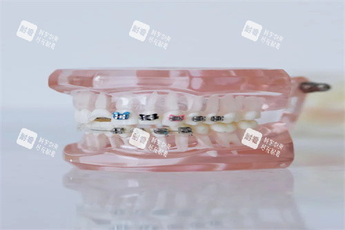 牙齿矫正的模型图.jpg 牙齿矫正的模型图.jpg
