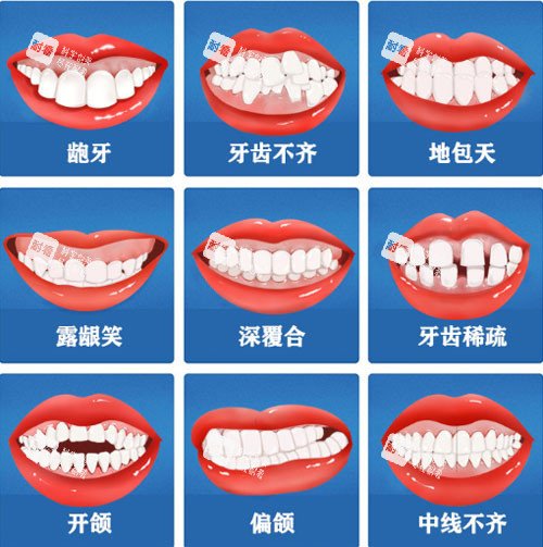 牙齿矫正适应症.jpg 牙齿矫正适应症.jpg
