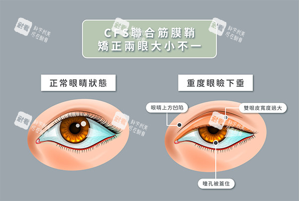眼肌无力cfs悬吊术.jpg