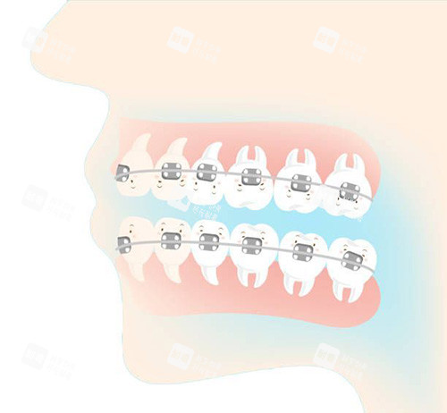 牙齿矫正侧面动画.jpg 牙齿矫正侧面动画.jpg