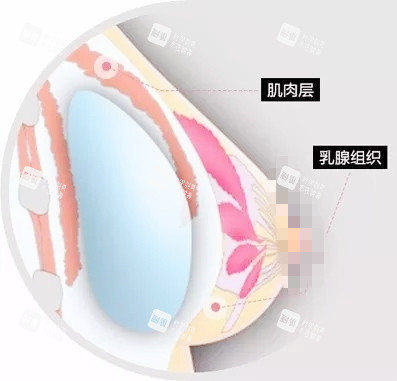 双平面丰胸.jpg