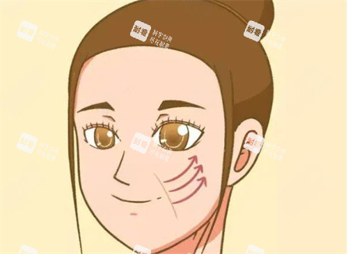 拉皮手术图片.jpg