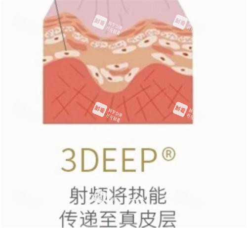 以色列3Deep相控射频作用.png 以色列3Deep相控射频作用.png