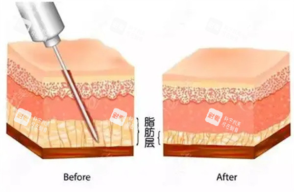 吸脂手术操作.jpg 吸脂手术操作.jpg