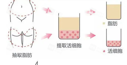 脂肪提取出来示意图.jpg 脂肪提取出来示意图.jpg