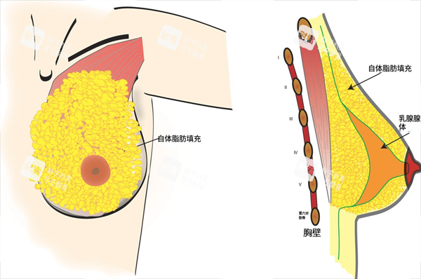 自体脂肪填充隆胸内部图 自体脂肪填充隆胸内部图