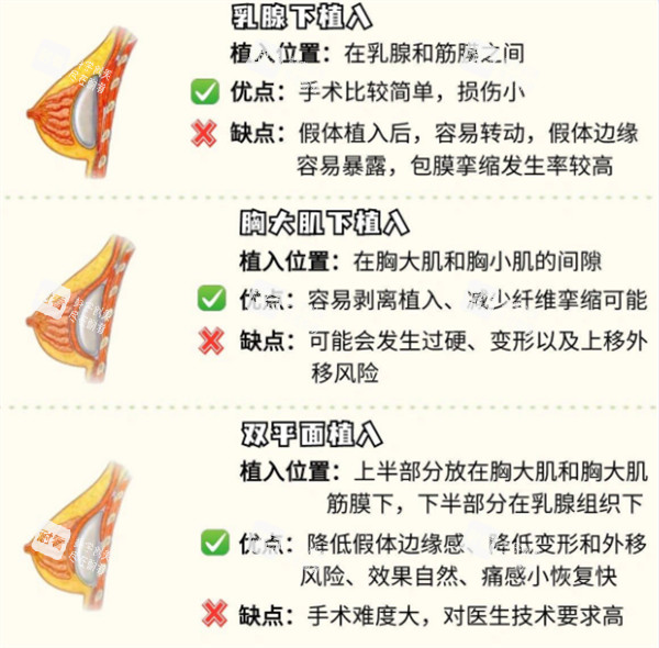 假体隆胸的不同植入位置图解.jpg 假体隆胸的不同植入位置图解.jpg