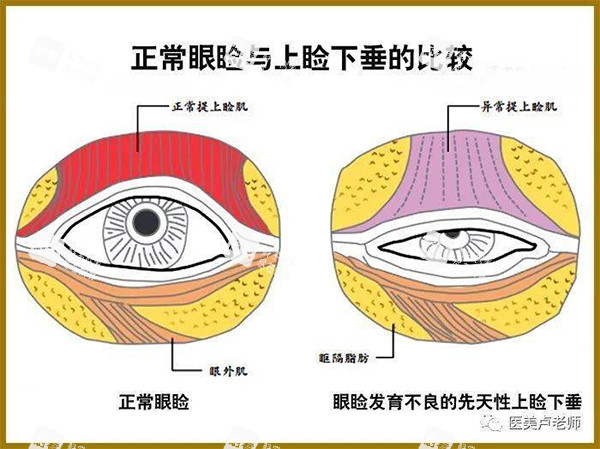 眼肌无力提升悬吊手术.jpg 眼肌无力提升悬吊手术.jpg