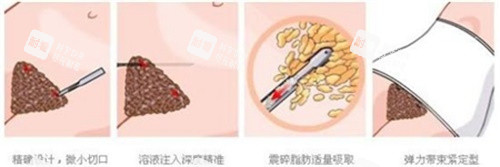 腹部吸脂示意图.jpg 腹部吸脂示意图.jpg