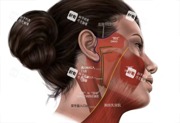 面部筋膜提升透视图.png 面部筋膜提升透视图.png