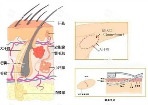 腋臭手术切口位置图解.jpg 腋臭手术切口位置图解.jpg