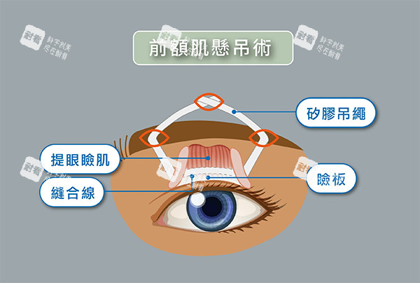 CFS额肌悬吊术怎么做的.jpg