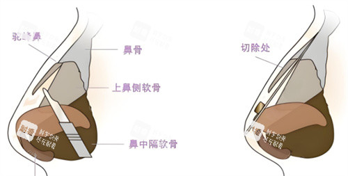 驼峰鼻矫正鼻部组织图.jpg 驼峰鼻矫正鼻部组织图.jpg