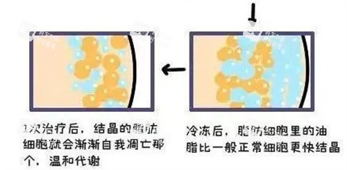 酷塑吸脂原理.jpg 酷塑吸脂原理.jpg