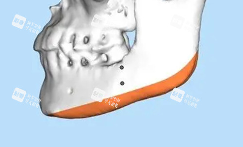 下颌角补骨示意图.jpg 下颌角补骨示意图.jpg