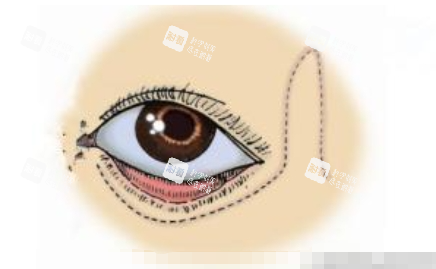 下眼睑外翻动画展示图.jpg.png 下眼睑外翻动画展示图.jpg.png