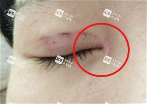 眼角疤痕增生实例图.png 眼角疤痕增生实例图.png