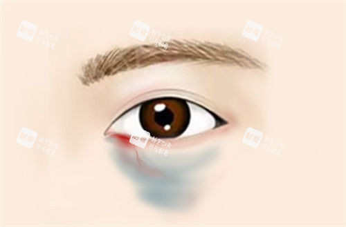 眼下出血发青动画展示图.jpg 眼下出血发青动画展示图.jpg