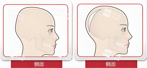 头部填充侧面对比动画图.jpg 头部填充侧面对比动画图.jpg