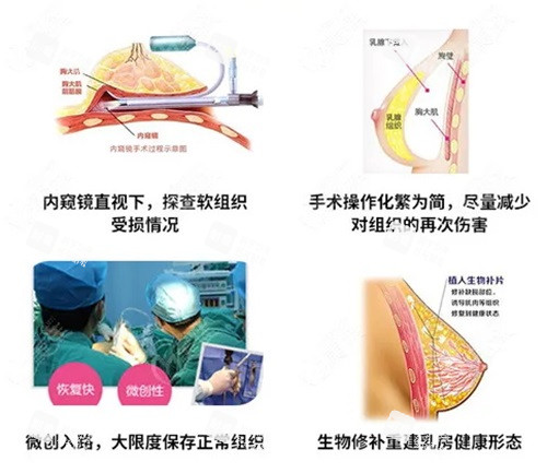 奥美定取出示意图.JPG