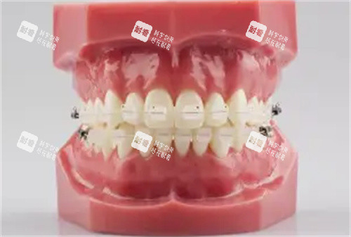 半隐形矫正牙齿模具图.jpg