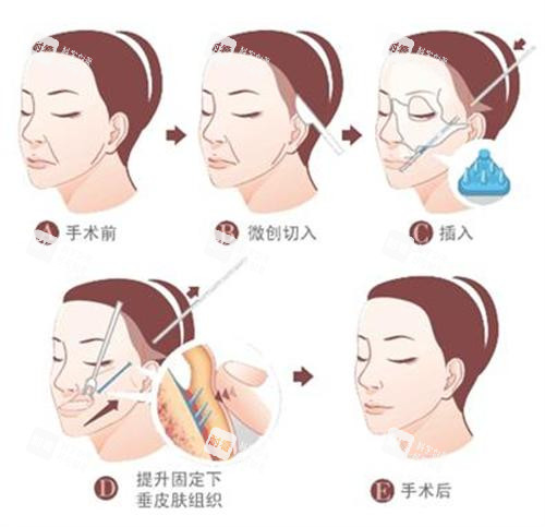 拉皮手术过程图.png