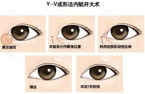 开眼角Y-V成型法.jpg