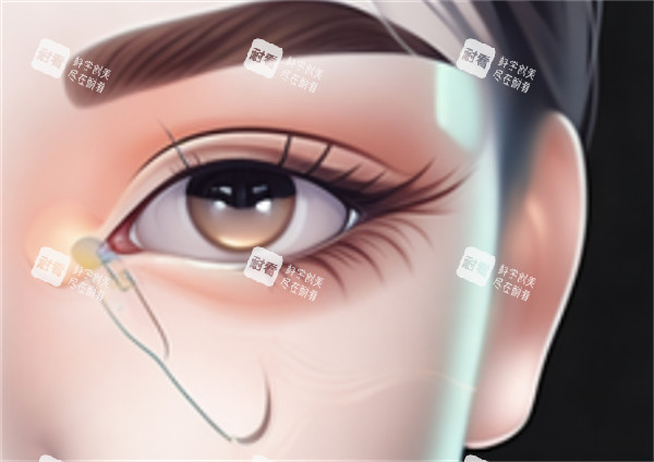 开眼角手术.jpg 开眼角手术.jpg