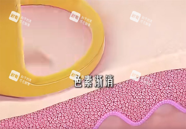 调Q激光改善黑色素.jpg 调Q激光改善黑色素.jpg