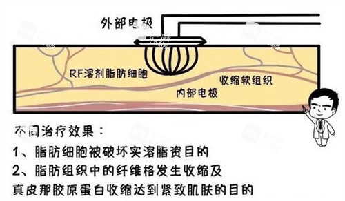 溶脂原理.jpg 溶脂原理.jpg