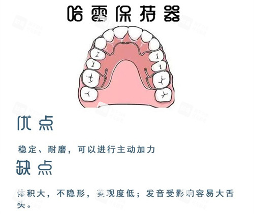 牙齿矫正哈雷保持器.jpg