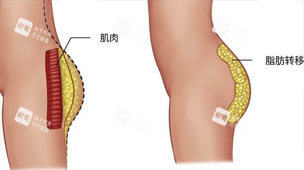 自体脂肪丰臀脂肪示意图.png 自体脂肪丰臀脂肪示意图.png