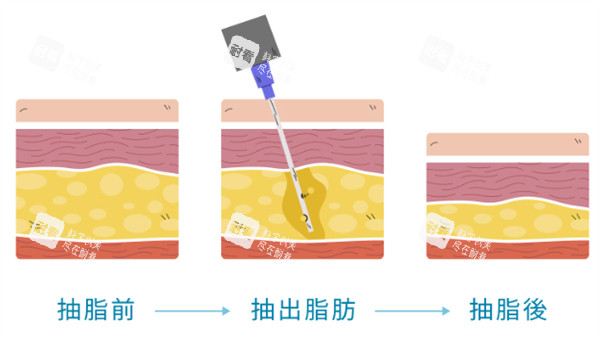 吸脂手术原理.jpg 吸脂手术原理.jpg