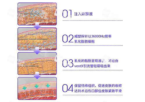 威塑吸脂手术步骤演示动画图.jpg