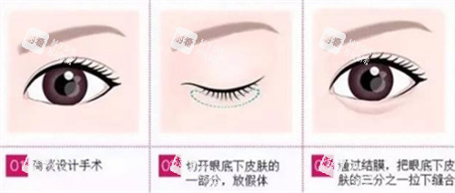 卧蚕手术步骤.jpg 卧蚕手术步骤.jpg