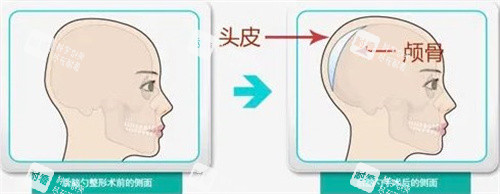 后脑勺手术.jpg
