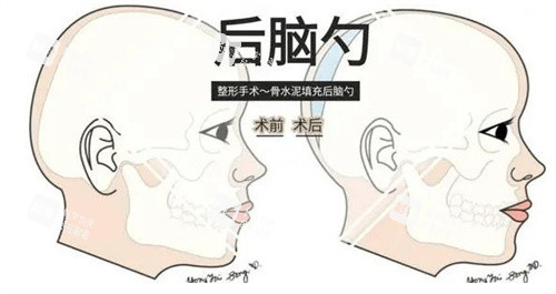 后脑勺填充手术前后.jpg