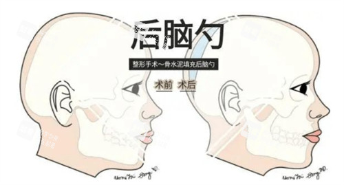 后脑勺填充对比.jpg