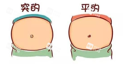 肚脐整形可改善的肚脐.jpg