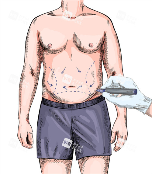 男生肚脐整形.jpg