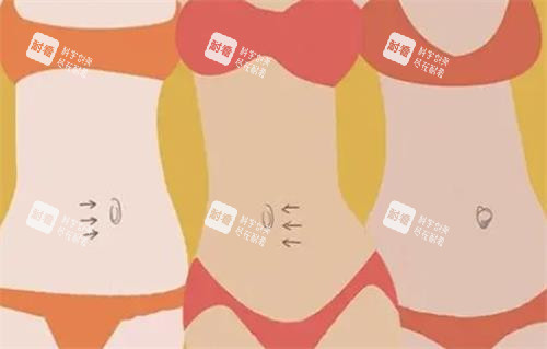 肚脐整形示意图.png