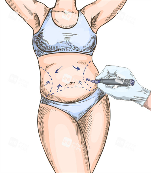 女生肚脐整形.jpg