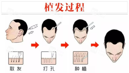 植发过程示意图.JPG 植发过程示意图.JPG