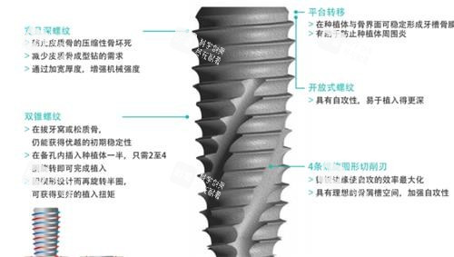 韩国柯威尔种植牙介绍.jpg