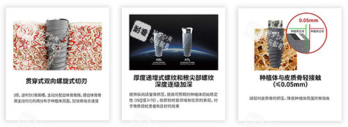 卡尔斯种植牙有什么不同.jpg 卡尔斯种植牙有什么不同.jpg