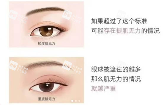 cfs眼肌无力.jpg cfs眼肌无力.jpg