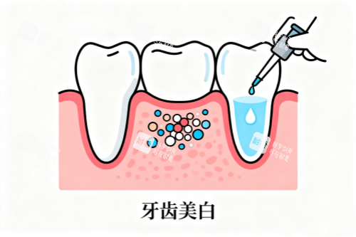 牙齿美白卡通展示图.png