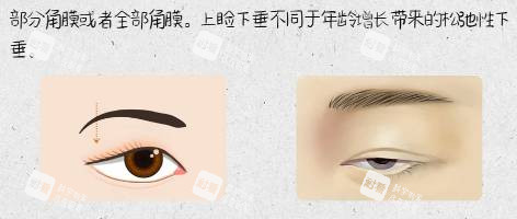 cfs额肌悬吊示意图.jpg