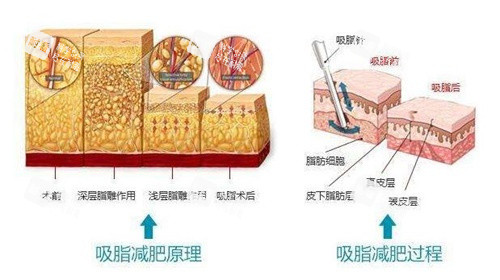 吸脂减肥原理.jpg 吸脂减肥原理.jpg