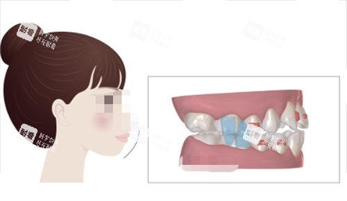 正雅隐形矫正S8突面矫正展示.png 正雅隐形矫正S8突面矫正展示.png